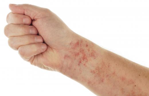 Skin irritation may cause red pores.