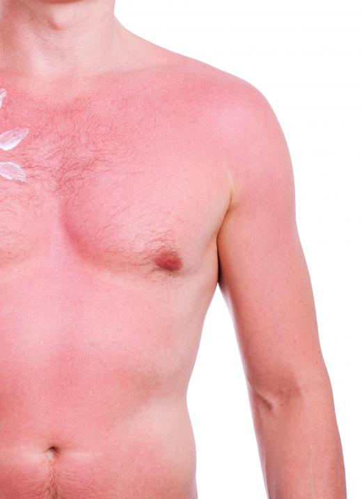 Military testing found that T-shirts protected wearers from sunburn to the shoulders.