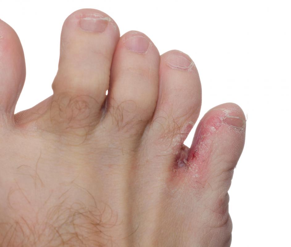 Paraffin may help treat feet blisters.