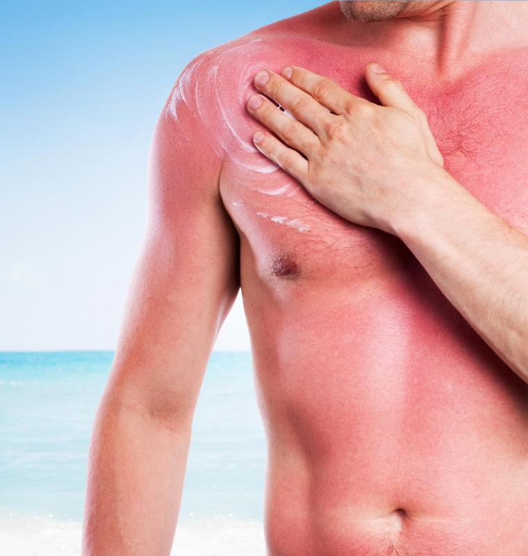 People with Fitzpatrick skin types I-II often sunburn easily.