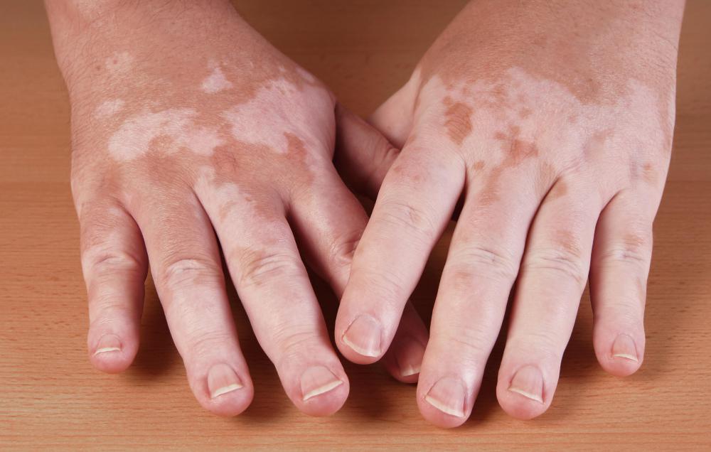 Liquid and cream concealers work well on conditions like vitiligo.