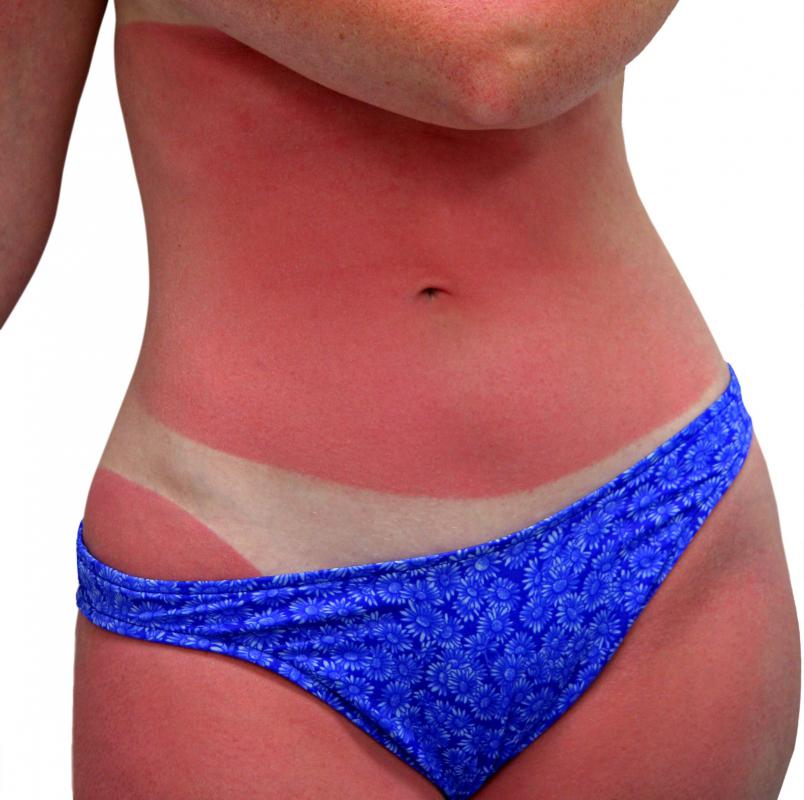 Black freckles called lengtigines are more common on those who have experienced a severe sunburn.