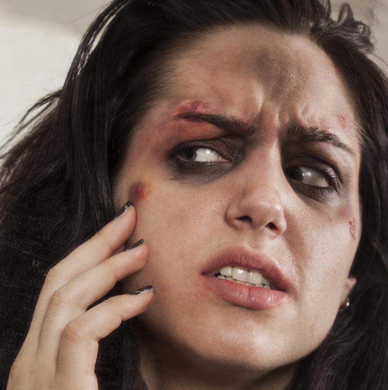 Vitamin K oxide may be used to address swelling and bruising under the eye.