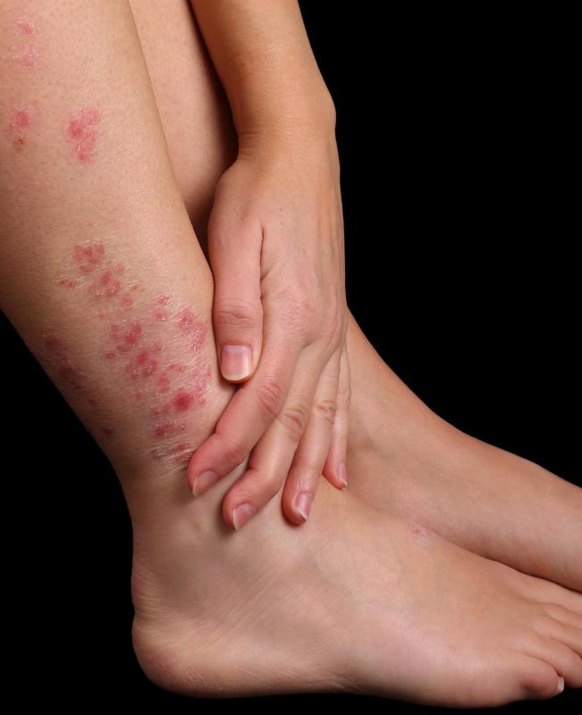 The main symptom of discoid eczema is skin rashes.