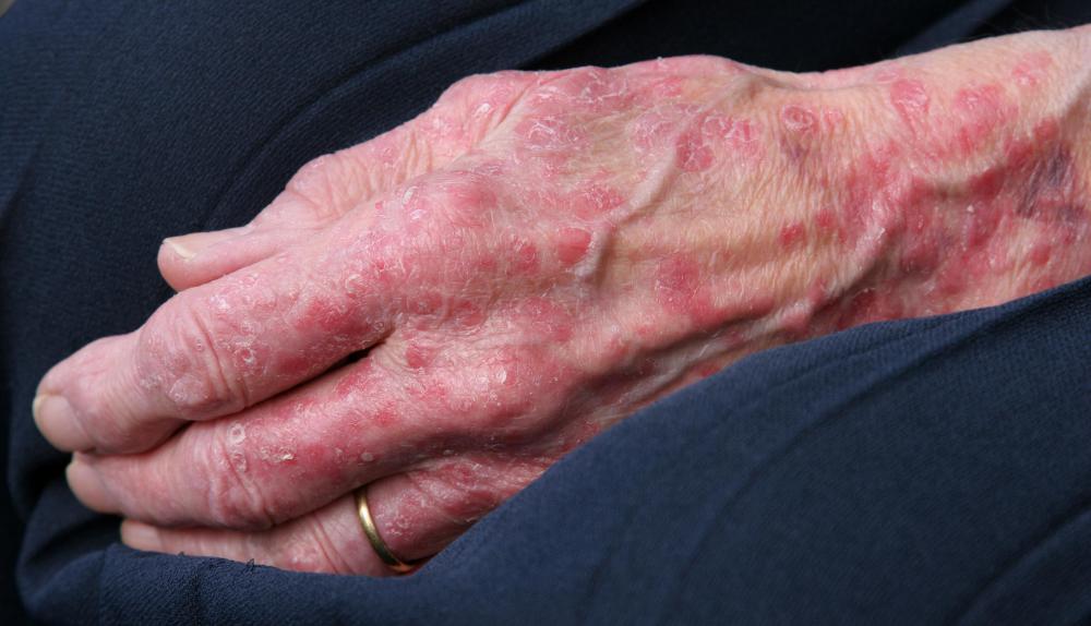 Lanolin may be found in products that treat rashes and other skin issues.