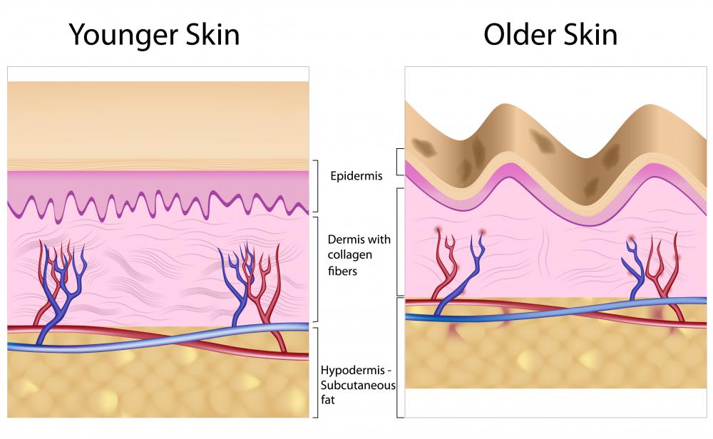 A diagram of younger skin and older skin showing how the decrease in collagen can lead to sagging and wrinkles.