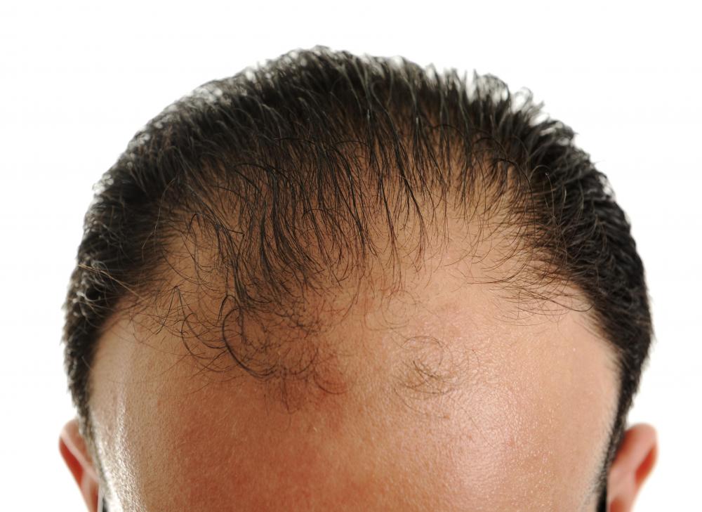 normal hairline