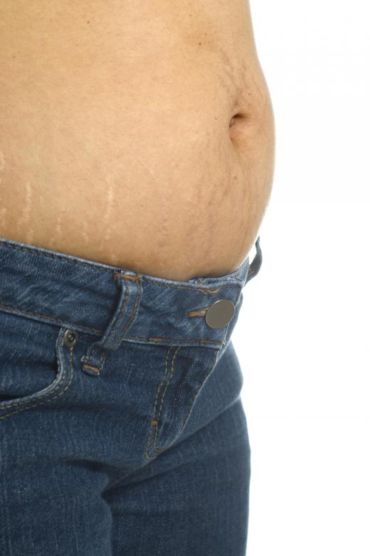 Vitamin E oil may help with stretch marks.