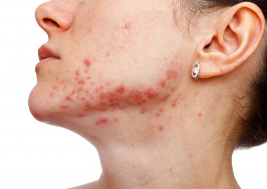 Facial veins can be the result of acne.