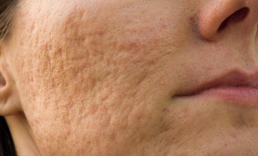 Dermabrasion can improve the appearance of acne scars.