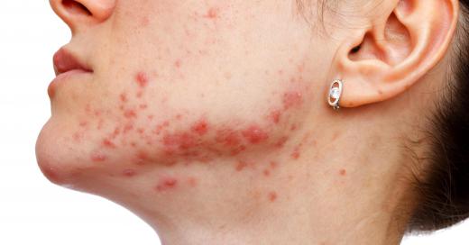 Facial peeling cream may help treat acne.