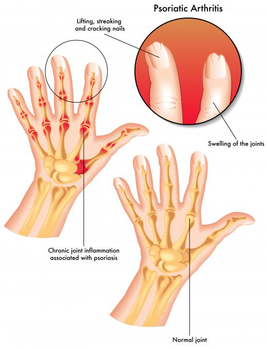 Psoriatic arthritis is often accompanied by psoriatic nail disease.