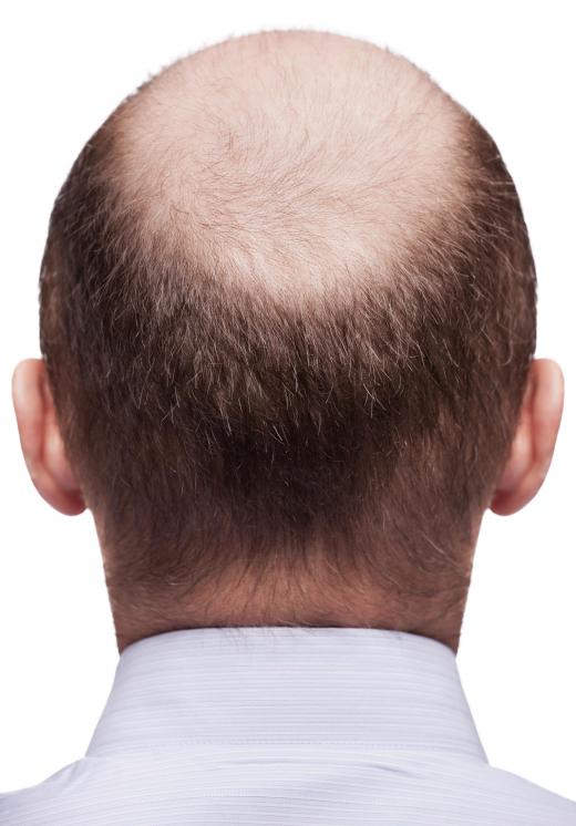 What are Hair Growth Patterns? (with pictures)