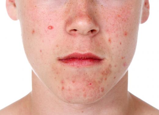 Over-the-counter medications used to treat acne may also be used in dandruff remedies.