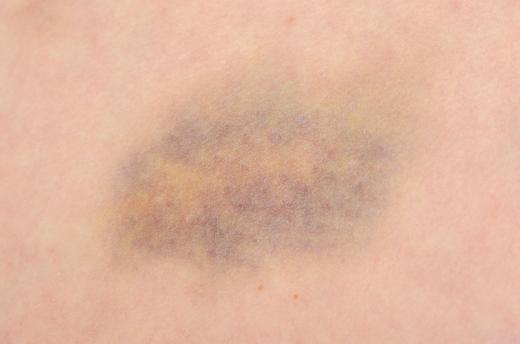 Vitamin K serum may be used to treat bruises.