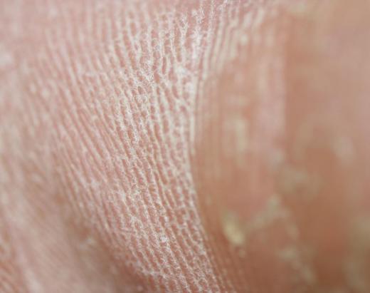 A callus may be defined as a patch of hard, rough skin that may develop due to friction.