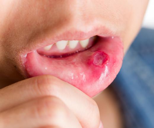 A canker sore is an open sore that forms in the mouth, also known as an aphthous ulcer.