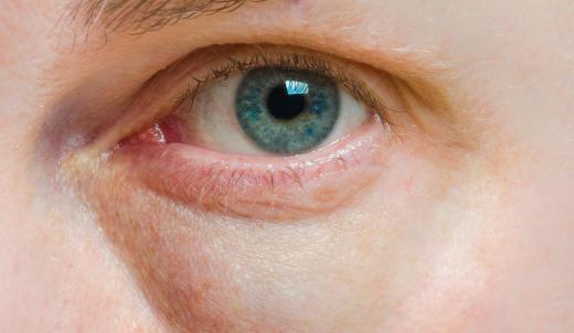 It may take two to three weeks before the bruising and swelling go away after eyelid surgery.