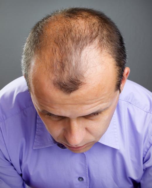 Male pattern baldness -- a receding hairline at the forehead and a bald patch at the back of the head -- can be caused by genetics and by low levels of the hormone testosterone.