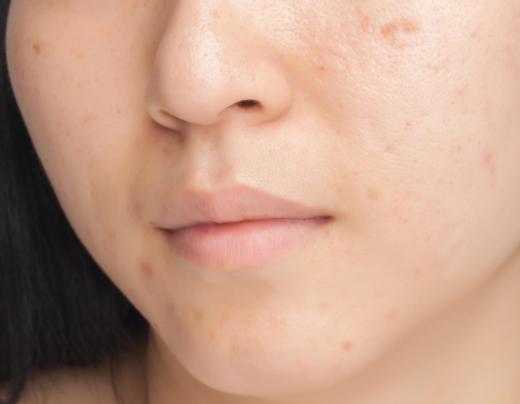 An ultrasonic facial treatment may be performed to treat acne.