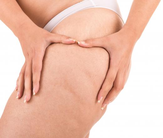 Retinol may be effective at reducing the appearance of cellulite when used for several months.