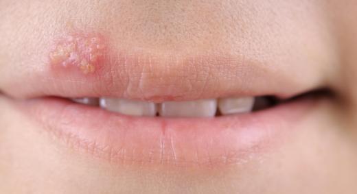 Glycolic facials are not a good idea for those who experience recurring cold sores.