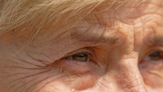 Crow's feet - wrinkles at the outer corner of the eye.