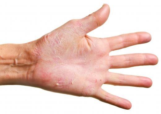 Vaseline can be used to treat dry skin on the hands.