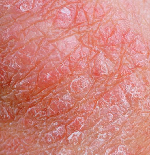 Zinc supplements can be used to treat eczema.