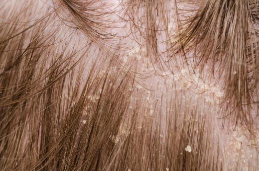 Urea lotions may be used to treat dry, flaky scalps.