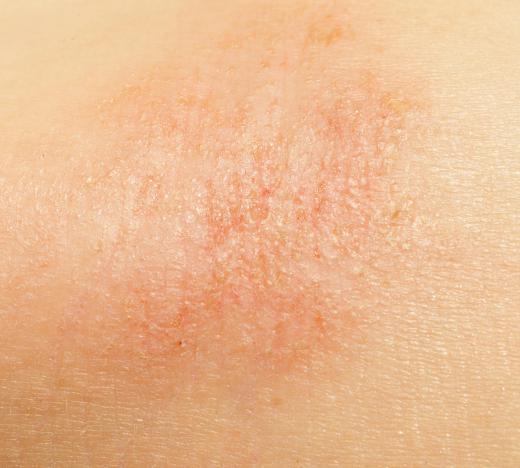 Combination skin has both dry and oily patches.