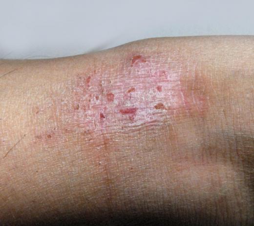 Eczema may be improved by using squalane oil.