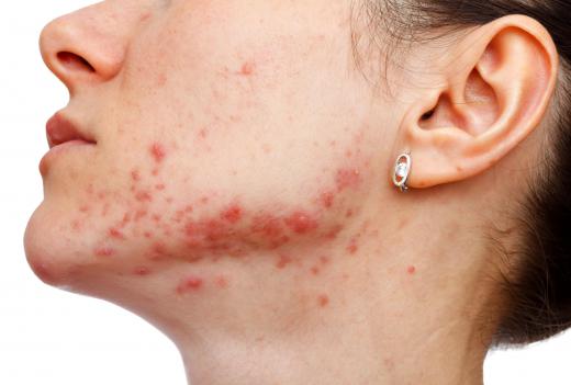 Pixel laser resurfacing might be effective in treating scars that result from severe acne.