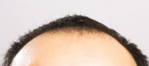 There are several methods to treat a dry hairline once the cause is determined.