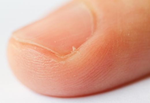 A person with a hangnail, which can be cut with a cuticle trimmer.