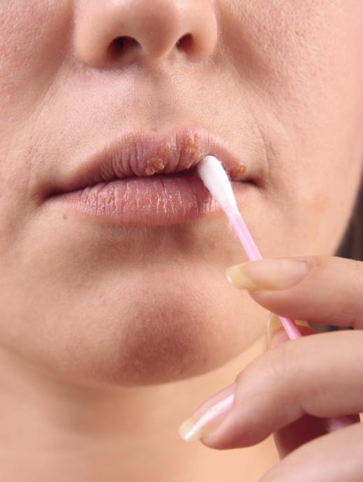 Skin numbing cream used on the face should be carefully applied to the affected area using a swab.