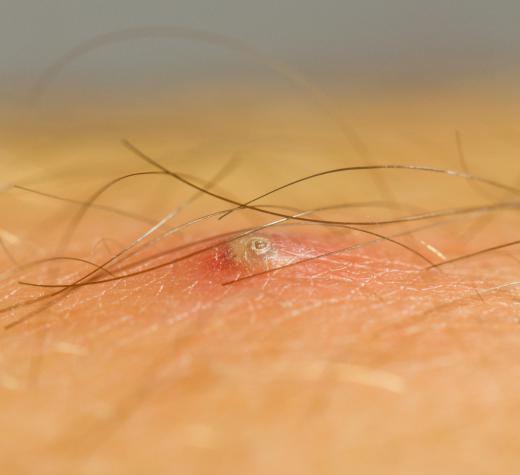 Mild electrolysis scars can be caused by ingrown hairs.