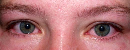 DHA can cause eye irritation.