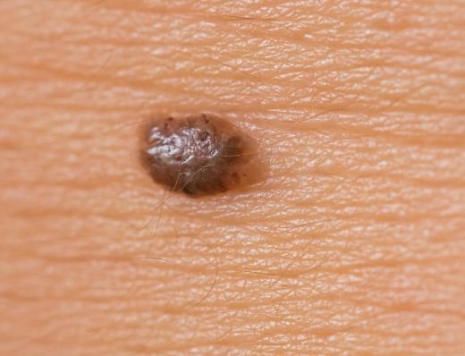 Moles may be used as a beauty mark.