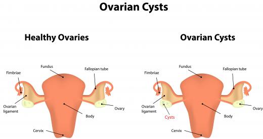 Squalane has been found in ovarian cysts.