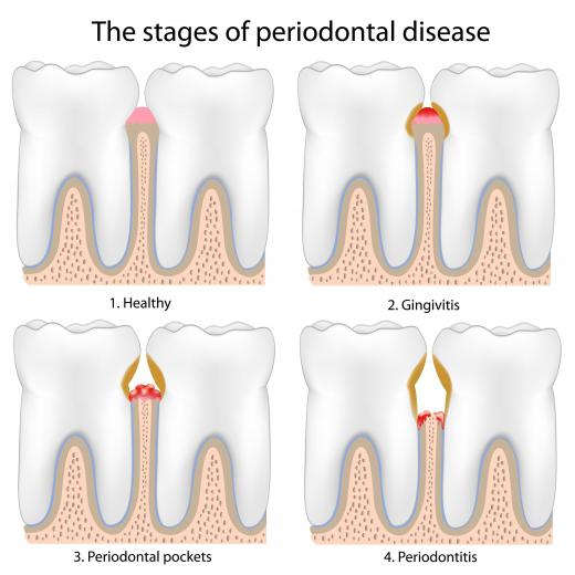 The stages of periodontal disease.