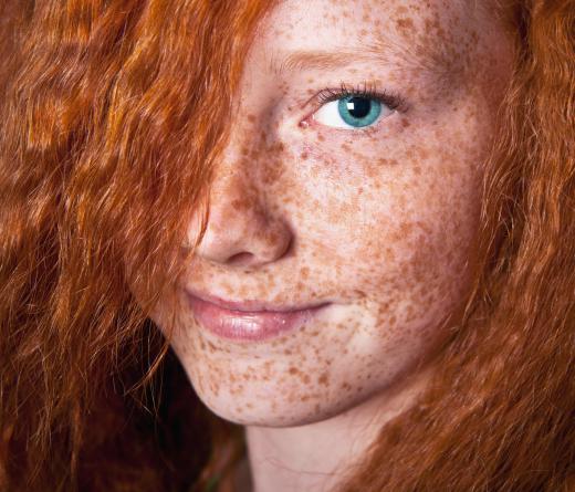 Light-skinned people with red hair are often prone to freckles.