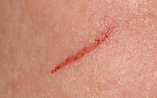 Vitamin E oil may be applied to scars.