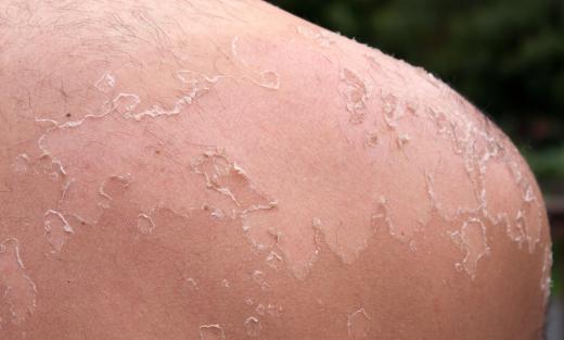 A person's shoulder peeling from a sunburn.