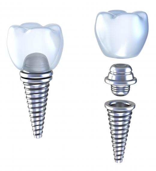 An illustration of the parts of a dental implant.