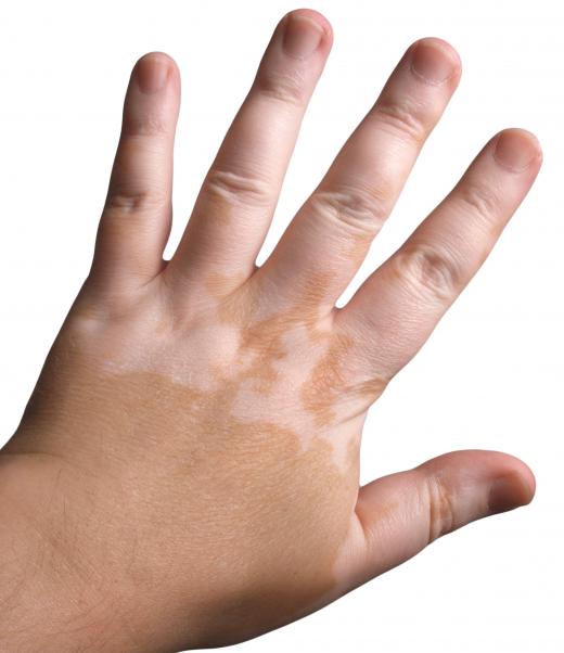 A person's hand with an uneven skin tone.