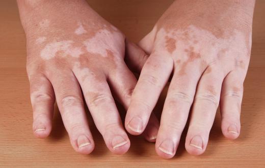 Liquid and cream concealers work well on conditions like vitiligo.