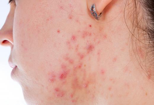 A person with moderate acne vulgaris has 20-100 comedones.