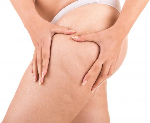 Some creams and lotions may improve the appearance of cellulite.