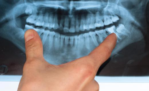 The wisdom teeth erupt at the ends of the jawline during late adolescence.